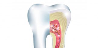 Root Canal Treatment