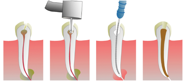 Root Canal Treatment 