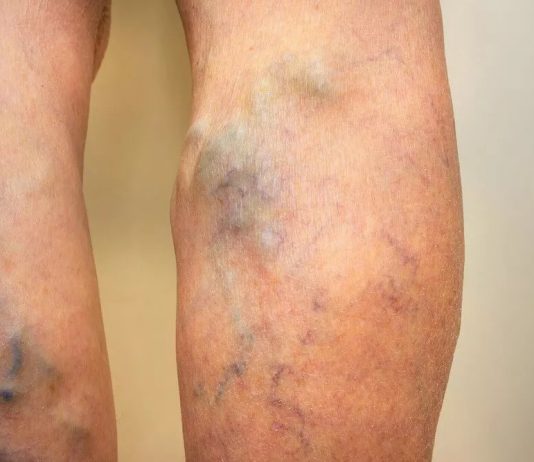 vein treatment Melbourne